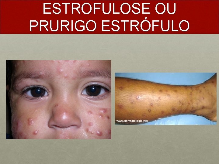 ESTROFULOSE OU PRURIGO ESTRÓFULO 