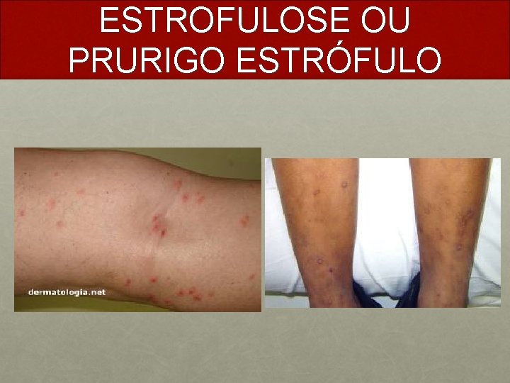 ESTROFULOSE OU PRURIGO ESTRÓFULO 