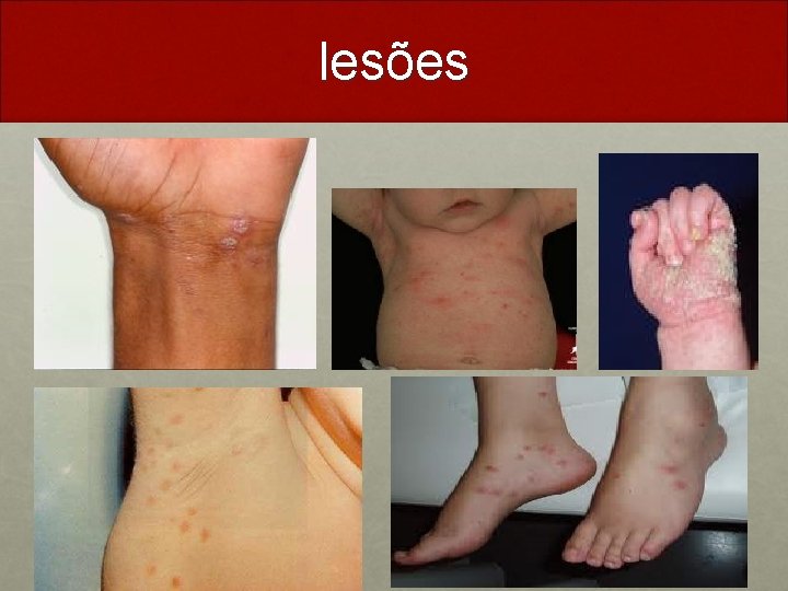lesões 
