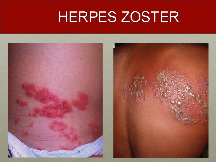 HERPES ZOSTER 