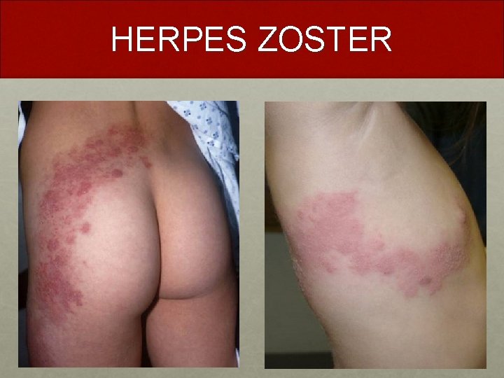 HERPES ZOSTER 