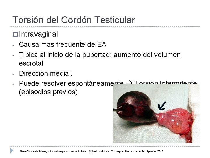 Torsión del Cordón Testicular � Intravaginal - Causa mas frecuente de EA Típica al