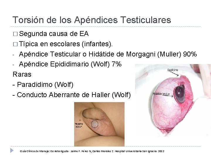 Torsión de los Apéndices Testiculares � Segunda causa de EA � Típica en escolares