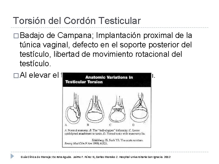 Torsión del Cordón Testicular � Badajo de Campana; Implantación proximal de la túnica vaginal,