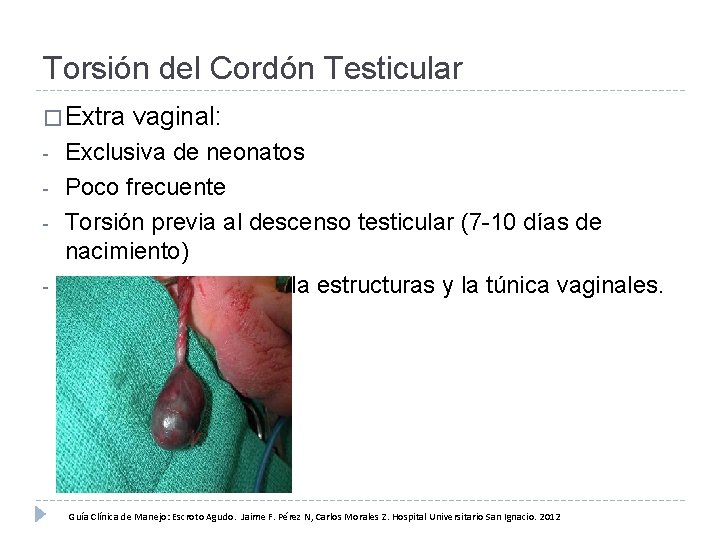 Torsión del Cordón Testicular � Extra - vaginal: Exclusiva de neonatos Poco frecuente Torsión