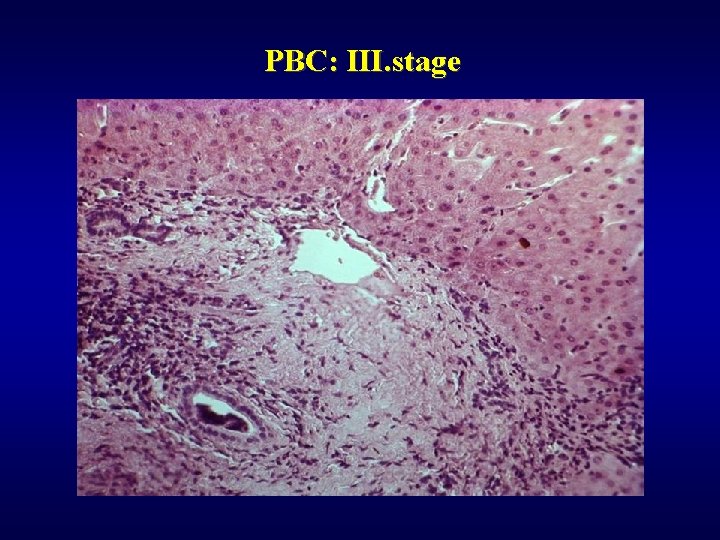 PBC: III. stage 