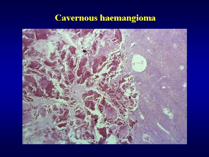 Cavernous haemangioma 