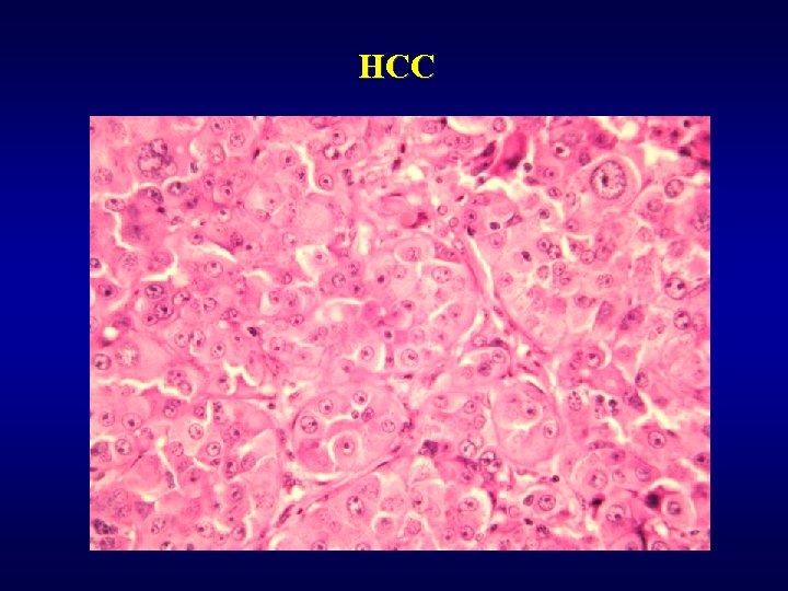 HCC 