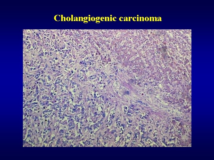 Cholangiogenic carcinoma 