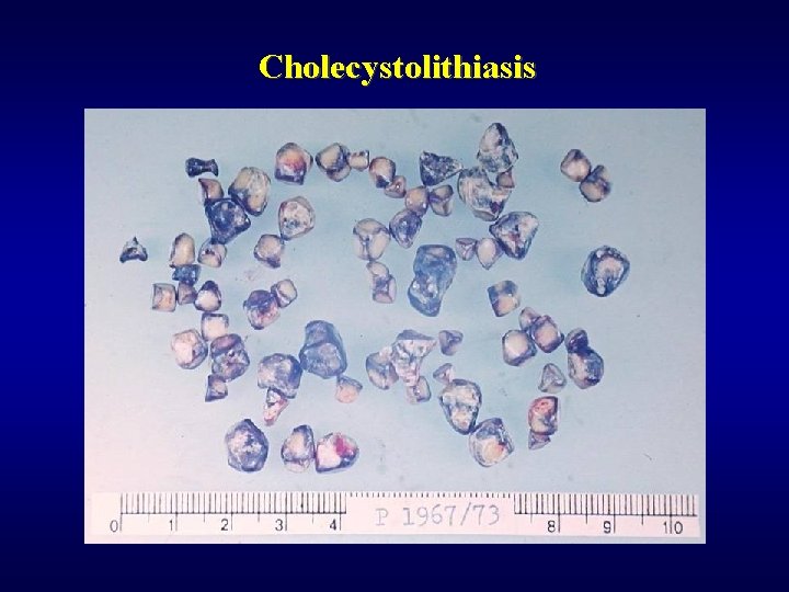 Cholecystolithiasis 