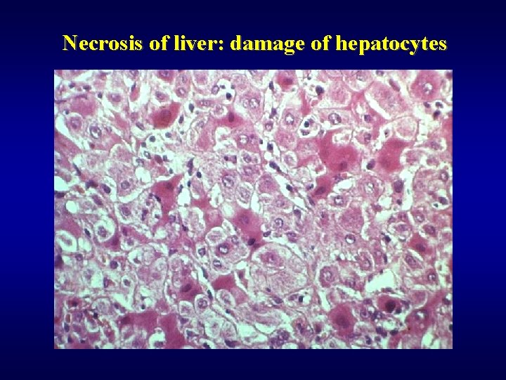 Necrosis of liver: damage of hepatocytes 