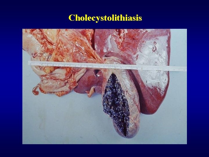 Cholecystolithiasis 