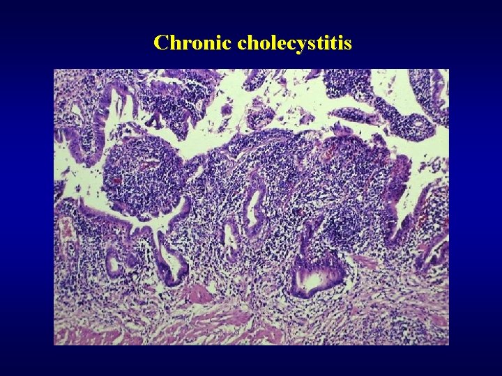 Chronic cholecystitis 