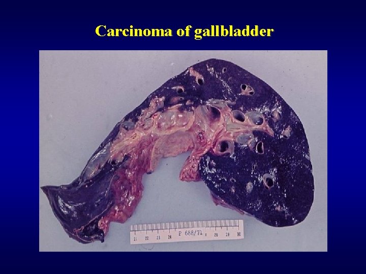 Carcinoma of gallbladder 