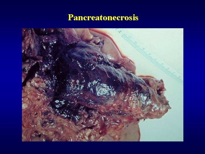 Pancreatonecrosis 