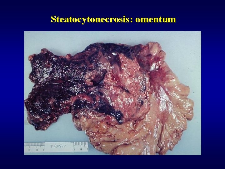 Steatocytonecrosis: omentum 