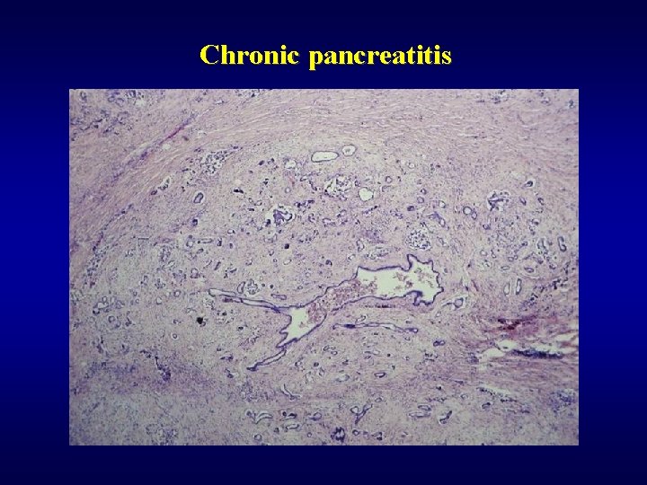 Chronic pancreatitis 