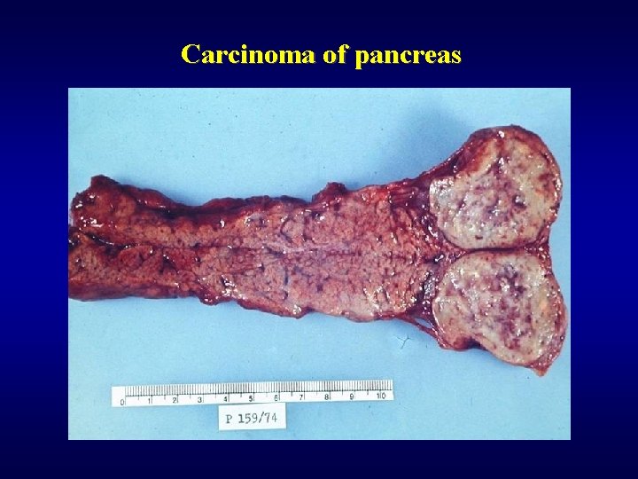 Carcinoma of pancreas 