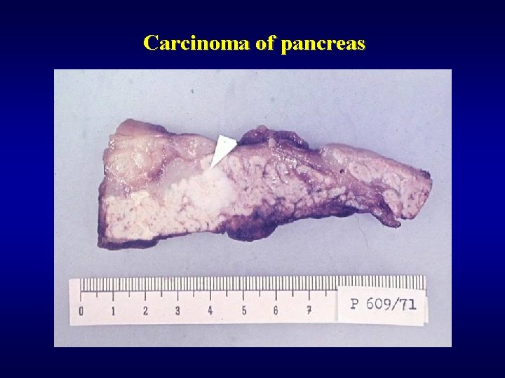 Carcinoma of pancreas 