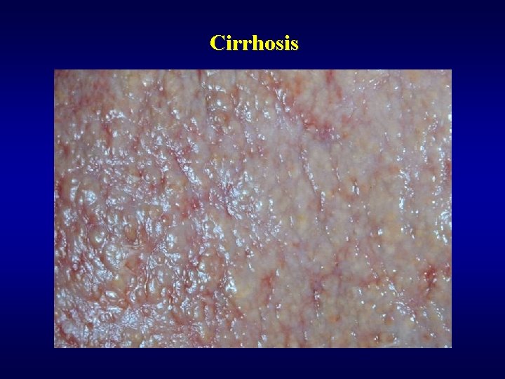 Cirrhosis 