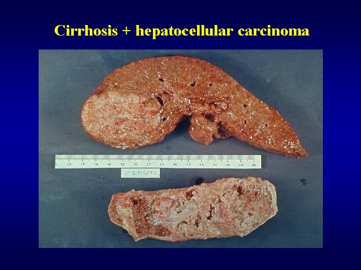 Cirrhosis + hepatocellular carcinoma 