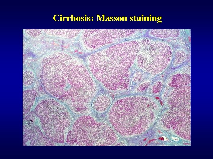 Cirrhosis: Masson staining 