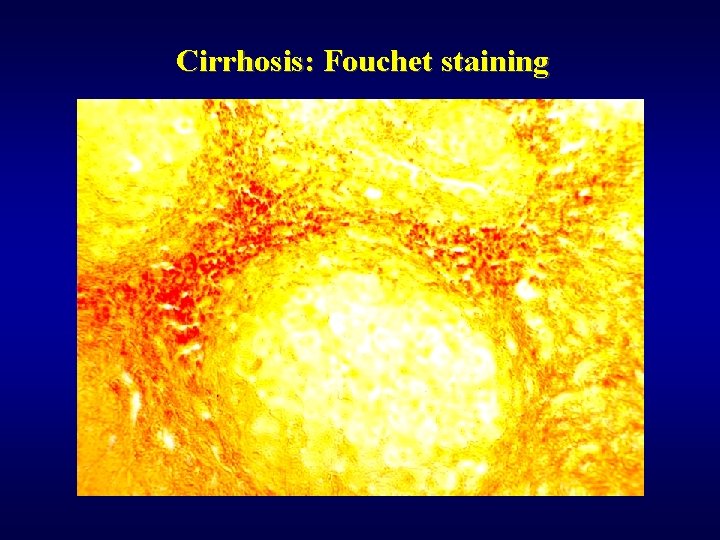 Cirrhosis: Fouchet staining 