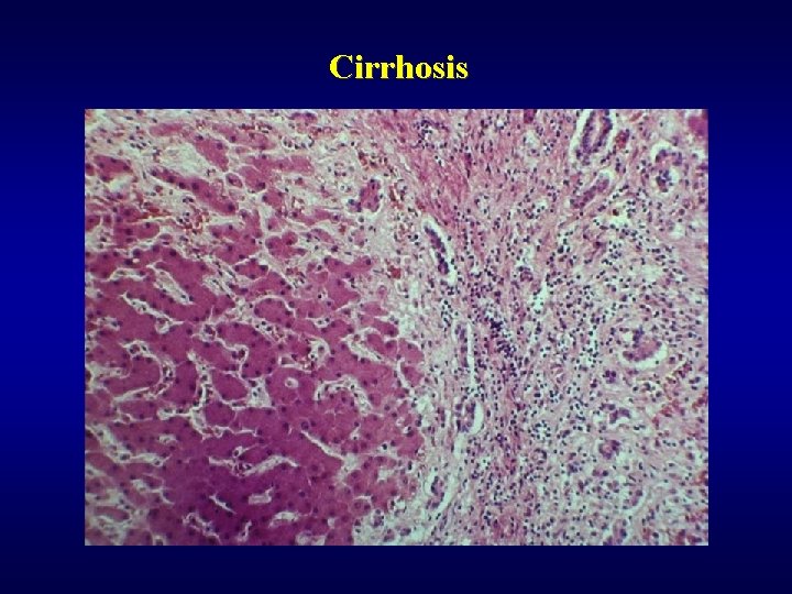 Cirrhosis 