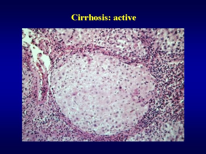 Cirrhosis: active 