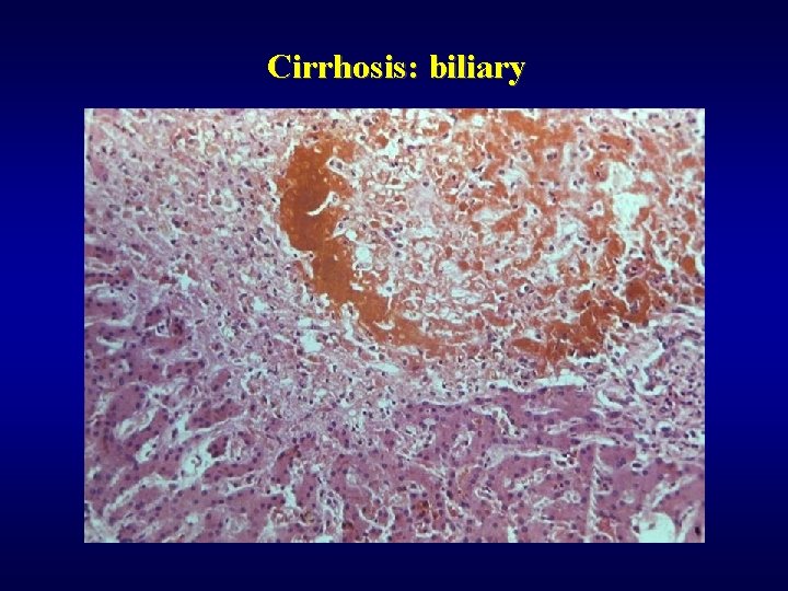 Cirrhosis: biliary 