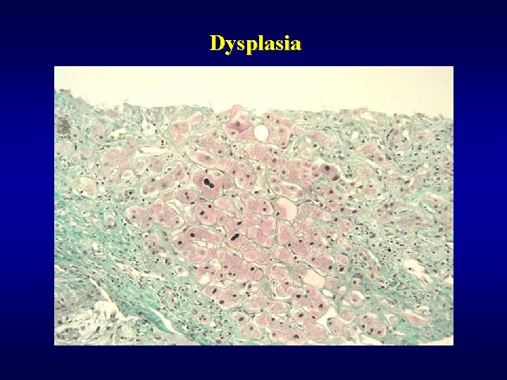 Dysplasia 