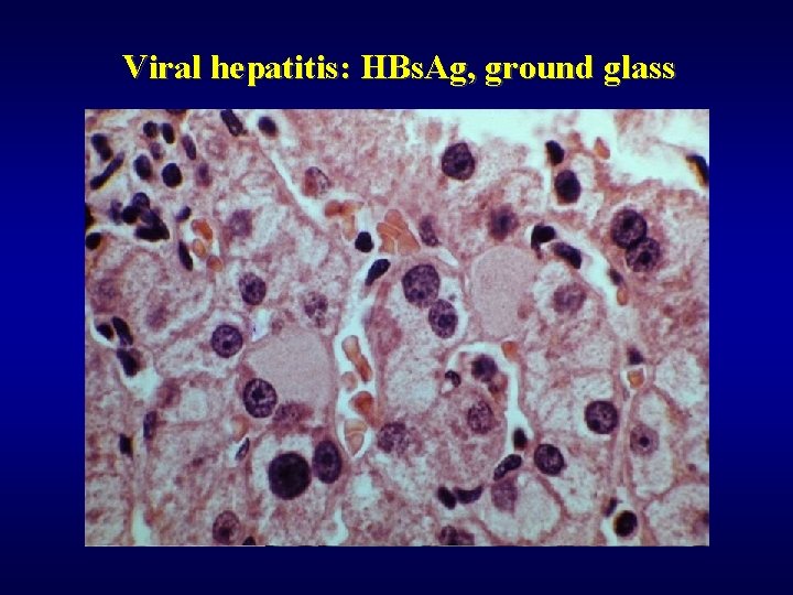 Viral hepatitis: HBs. Ag, ground glass 
