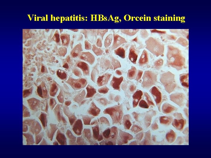 Viral hepatitis: HBs. Ag, Orcein staining 