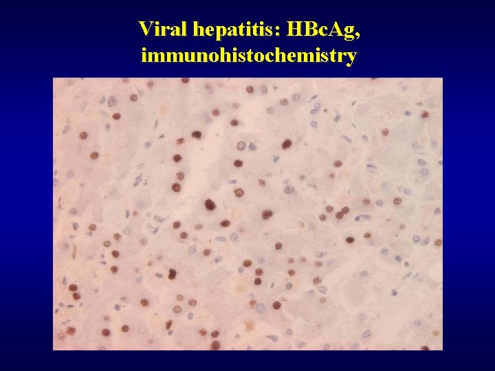 Viral hepatitis: HBc. Ag, immunohistochemistry 