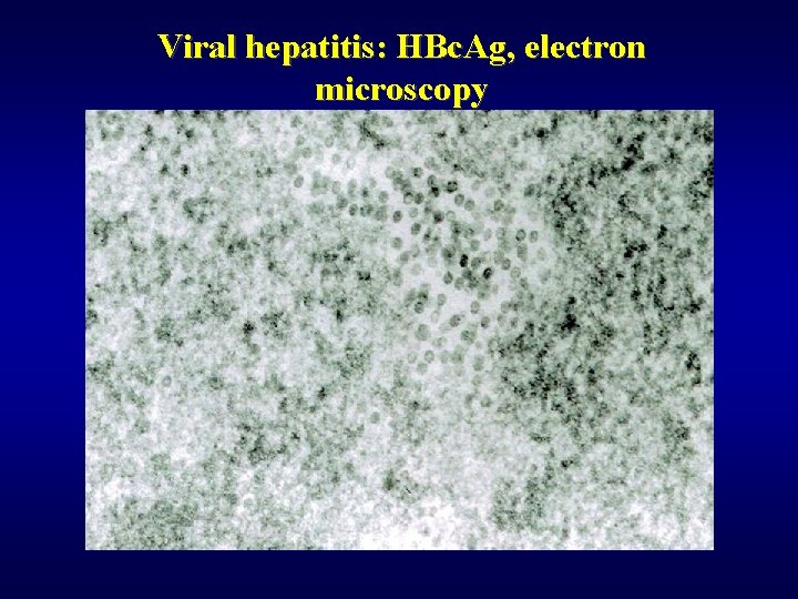 Viral hepatitis: HBc. Ag, electron microscopy 