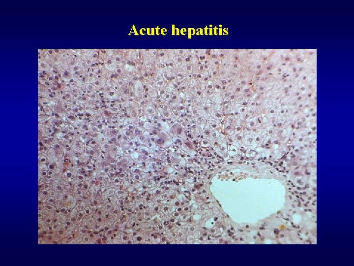 Acute hepatitis 