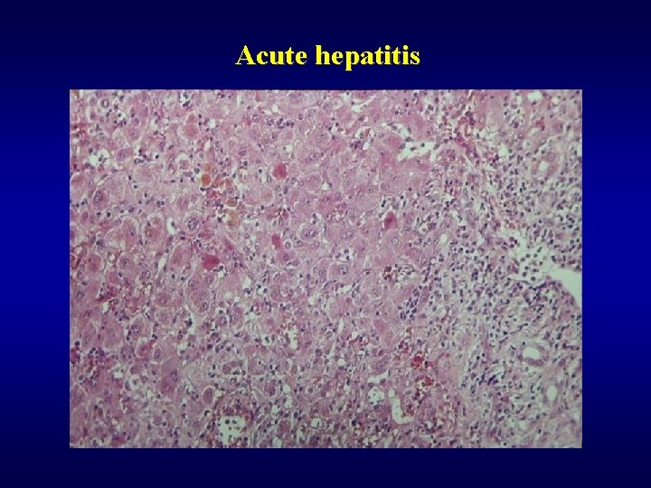 Acute hepatitis 