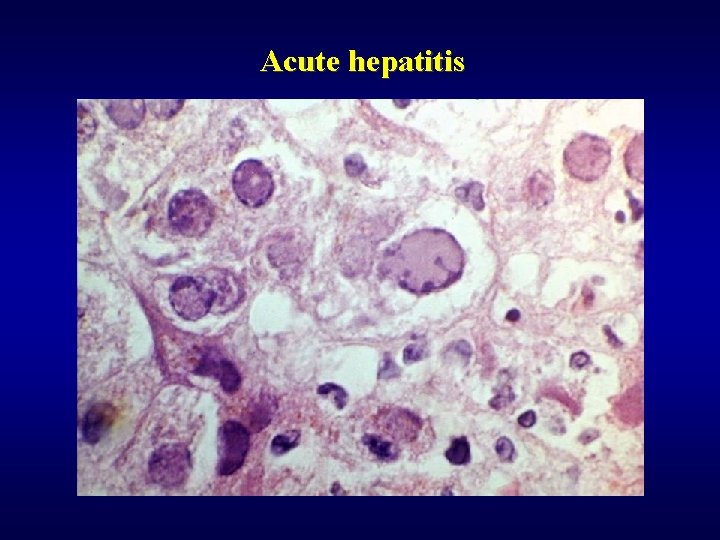 Acute hepatitis 