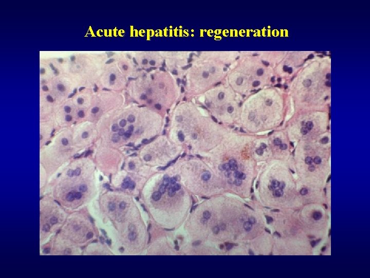 Acute hepatitis: regeneration 