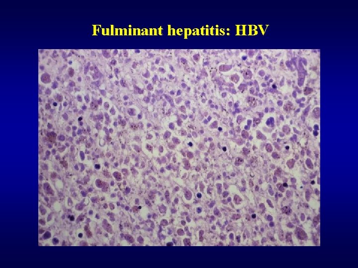 Fulminant hepatitis: HBV 