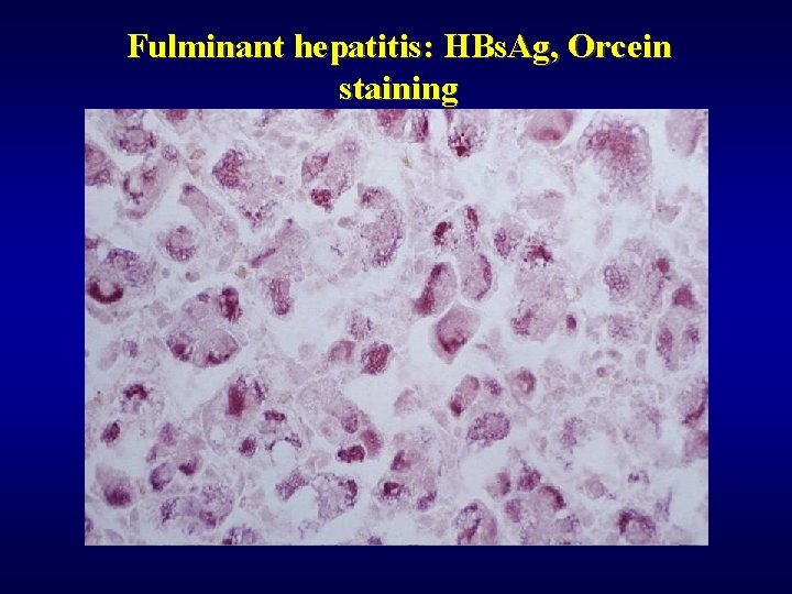 Fulminant hepatitis: HBs. Ag, Orcein staining 