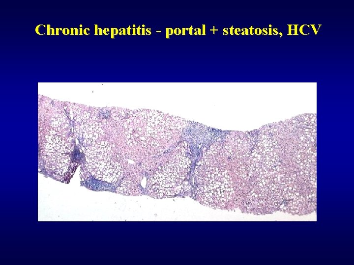 Chronic hepatitis - portal + steatosis, HCV 