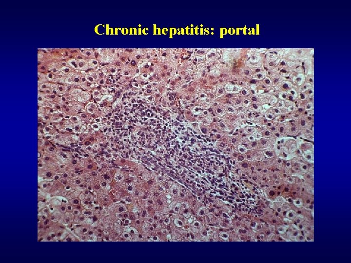 Chronic hepatitis: portal 