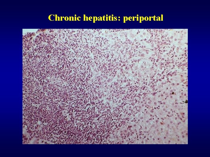 Chronic hepatitis: periportal 