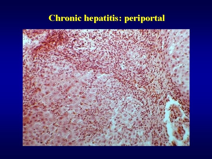 Chronic hepatitis: periportal 