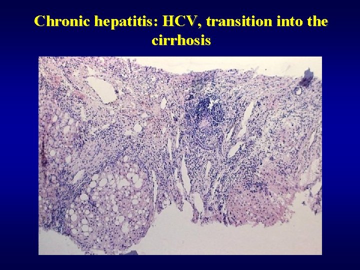 Chronic hepatitis: HCV, transition into the cirrhosis 