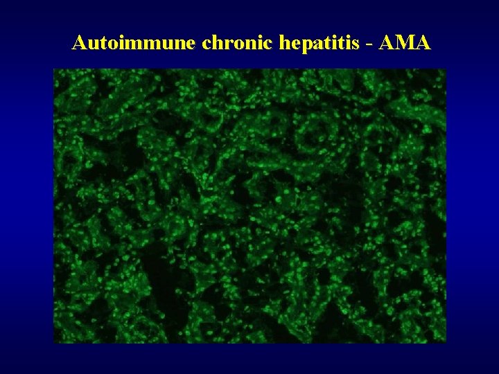 Autoimmune chronic hepatitis - AMA 