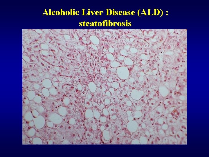 Alcoholic Liver Disease (ALD) : steatofibrosis 