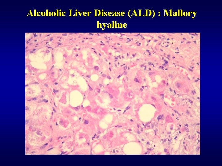 Alcoholic Liver Disease (ALD) : Mallory hyaline 
