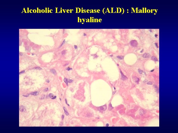 Alcoholic Liver Disease (ALD) : Mallory hyaline 